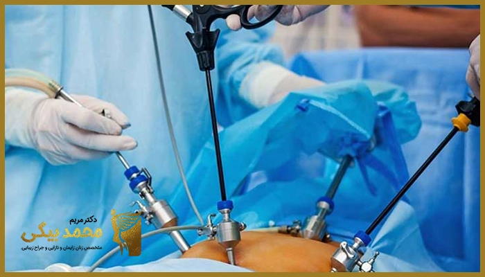 لاپاراسکوپی چه زمانی انجام میشود؟