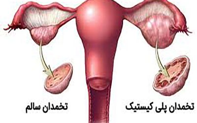 تنبلی تخمدان یا تخمدان پلی کیستیک
