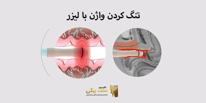 تنگ کردن واژن با لیزر