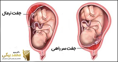 تفاوت جفت سر راهی و جفت طبیعی در جنین